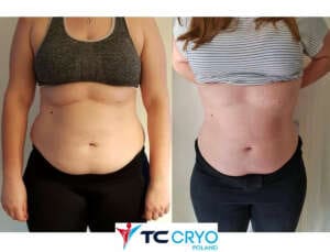 TC Cryo - przed-po kriolipoliza kontrastowa